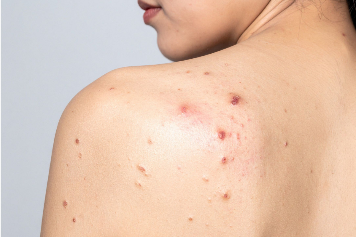 Skin Condition