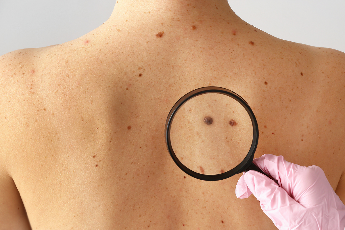 moles
