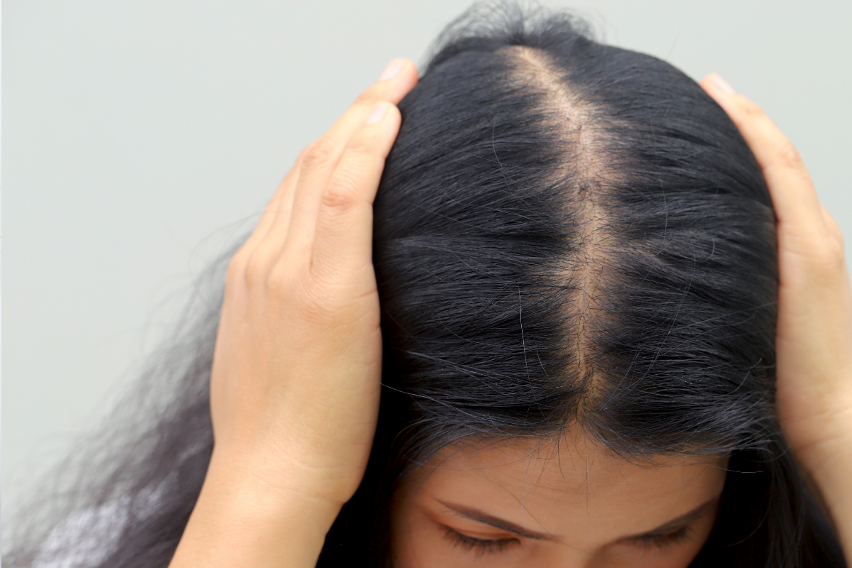 Hair Loss