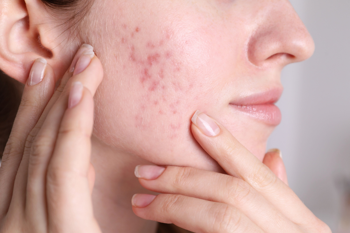 Acne & Scars