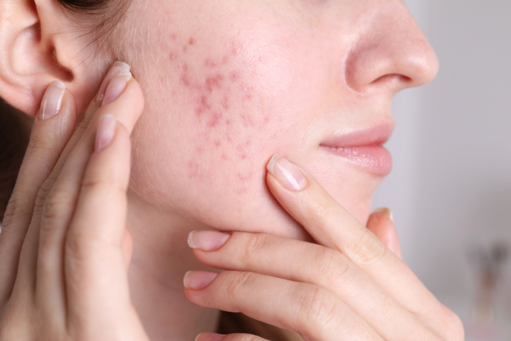 microneedling vs laser for acne scars
