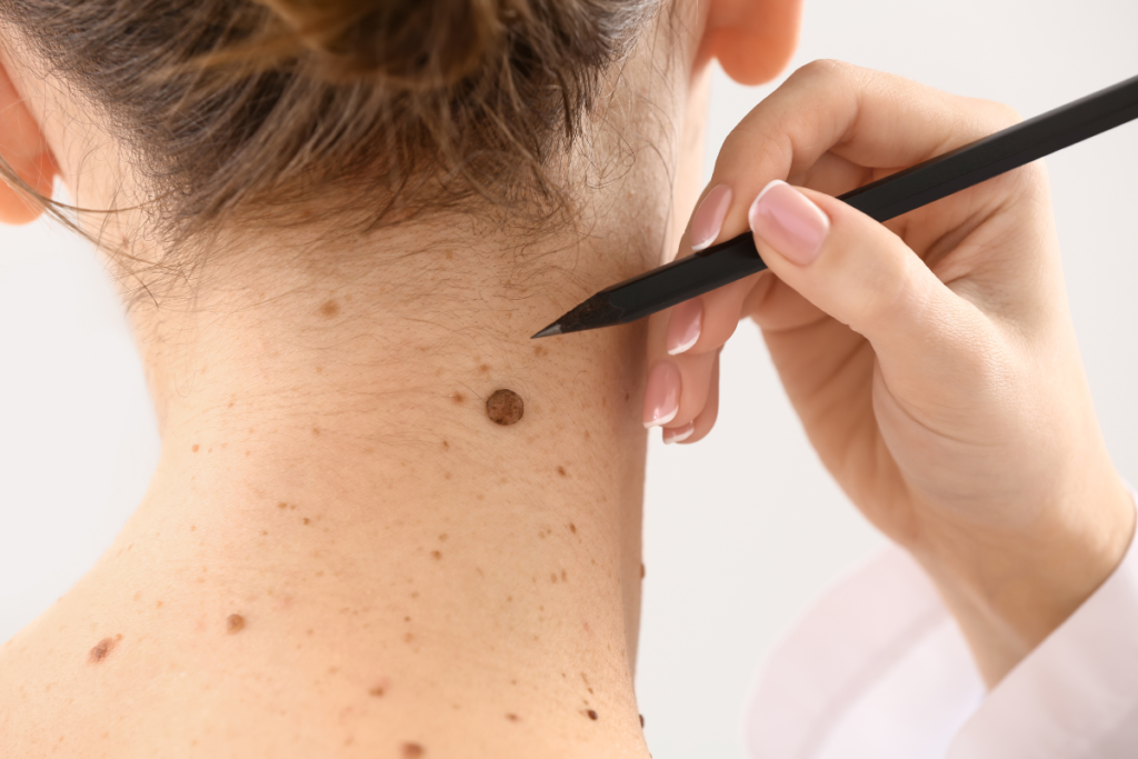 mole vs wart vs skin tag