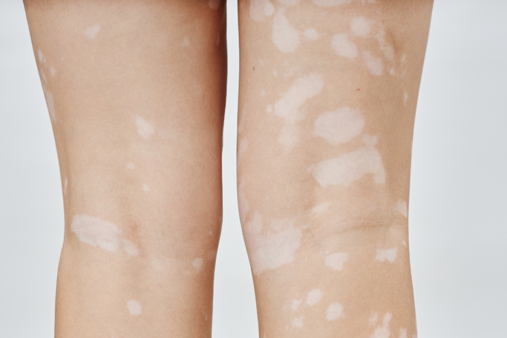 white patches on skin
